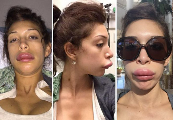 Звезда MTV изуродовала губы пластической операцией